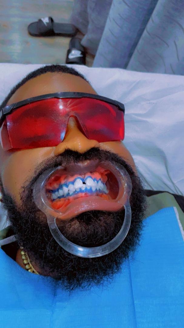 2 section of teeth whitening + regular cleaning